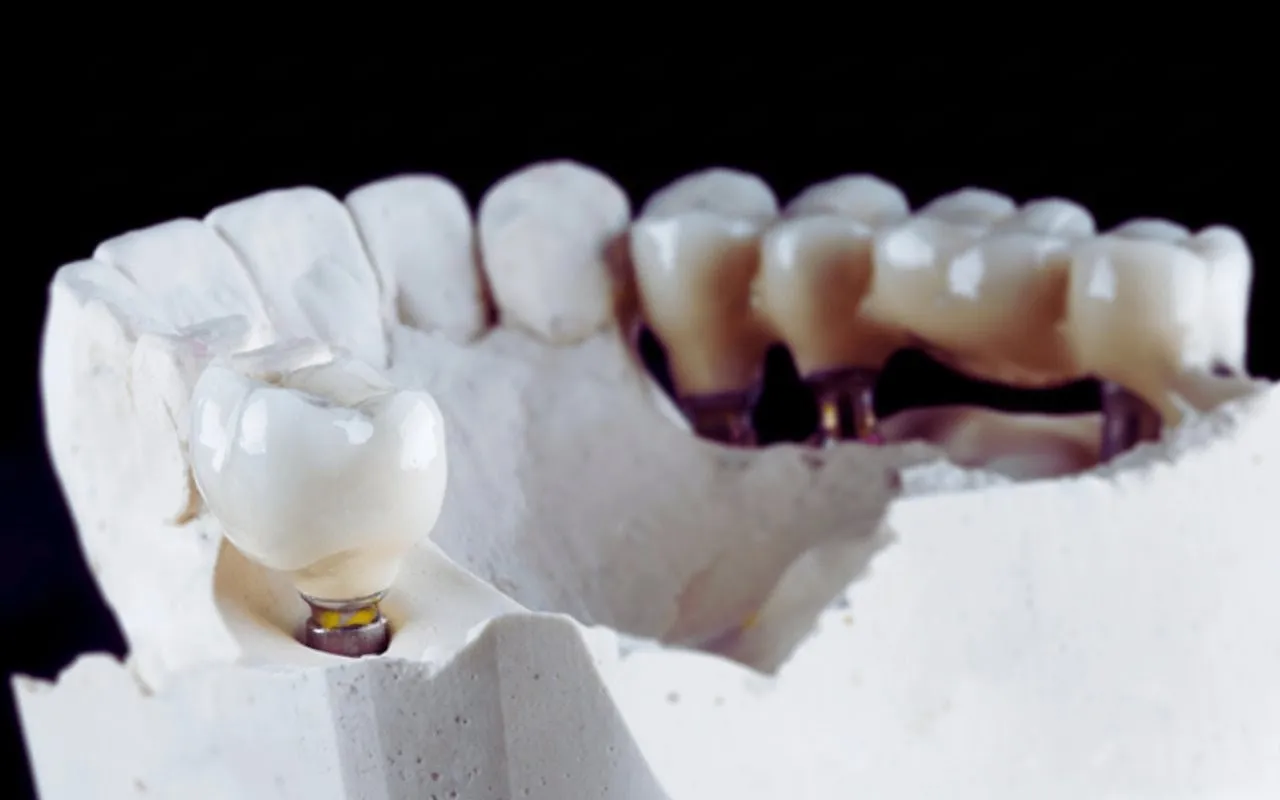 Types of Dental Bridges